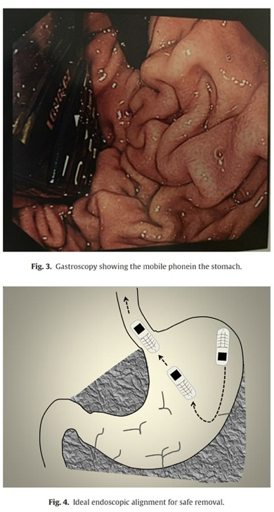 Illustration for article titled What Happens if You Swallow Your Cell Phone? Nothing Good.